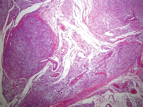 Hemangiopericytoma/Solitary Fibrous Tumor of the Oral Cavity