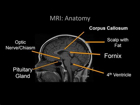 Mri Brain Anatomy