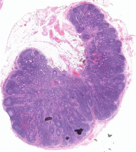 Lymph node - Pathology dictionary - MyPathologyReport