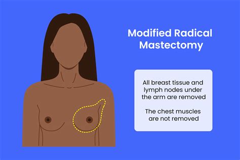 Modified Radical Mastectomy: Procedure, Risks and Recovery