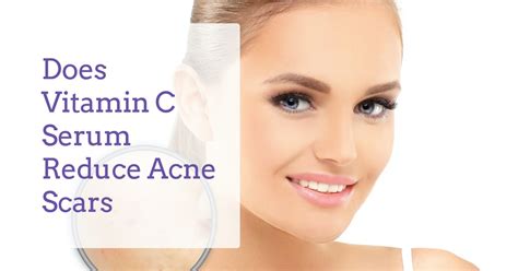 How does Vitamin C Serum help to reduce your acne scar? – Derma Essentia