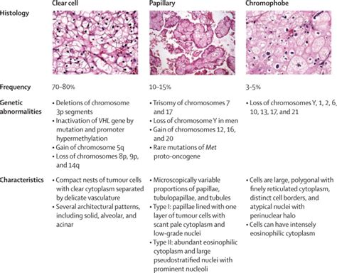 Renal cell carcinoma - The Lancet