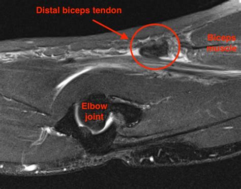 Distal Biceps Tendon Rupture | The Bone School