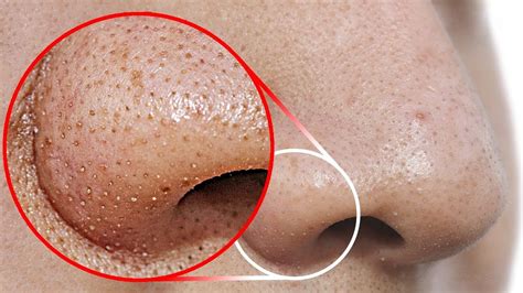 Do THIS to Remove Blackheads From Your Nose - YouTube