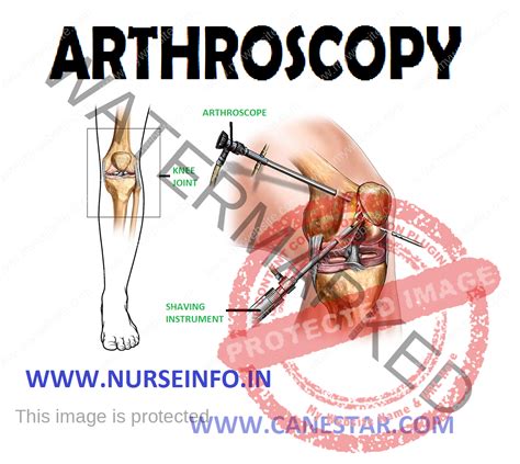 ARTHROSCOPY - Nurse Info