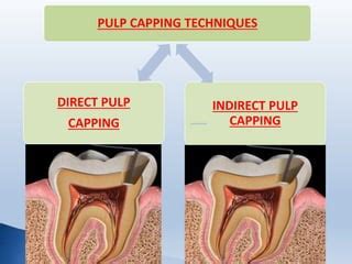 Pulp capping | PPT