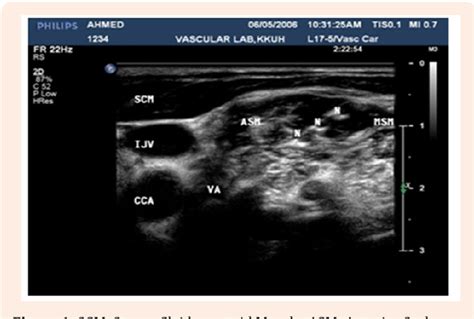 Figure 1 from Ultrasound-Guided Interscalene Nerve Block: An Alternative Technique to Anatomical ...