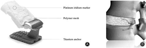 (A) Anular closure device (Barricaid) consisting of a titanium anchor... | Download Scientific ...