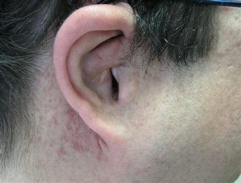 What is Plexiform Neurofibroma? Treatment, Symptoms, Pictures « CancerWORLD Cancer Treatment ...