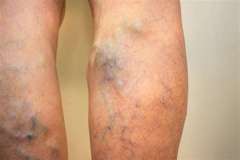 Harvard Trained Vein Doctors | Can Venous Insufficiency Be Cured? | Leg Veins Treatment Before ...