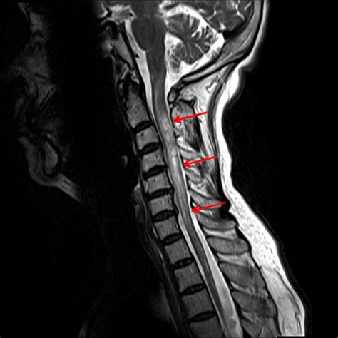 Spinal Lesions On MRI