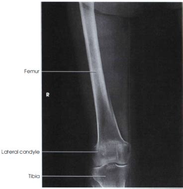 AP PROJECTION: FEMUR - MID AND DISTAL - RadTechOnDuty