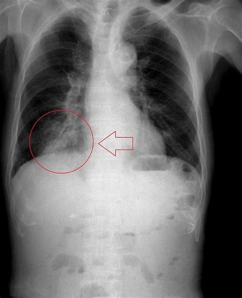 Pneumonia Aspirasi: Penyebab, Gejala, Komplikasi, Pengobatan