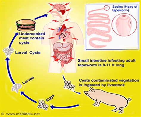 Tapeworms In The Brain