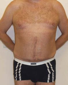 Incisional Hernia - Melbourne Hernia Clinic