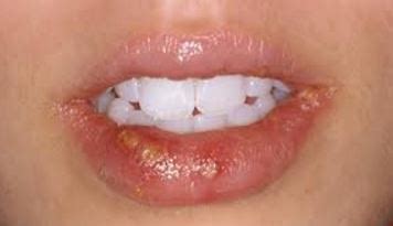 Sunburned Lips: Blisters, Swollen Rash, Remedies to Heal Fast & How Long It Lasts