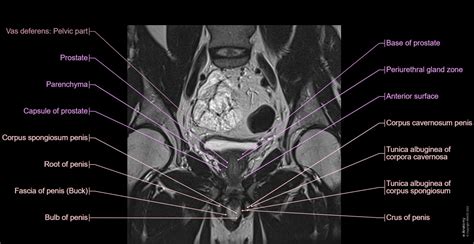 Floor Muscles Anatomy Radiology - Carpet Vidalondon