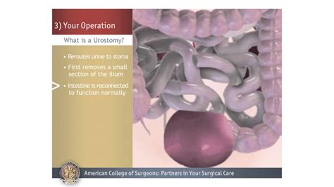 Urostomy: Your Operation - YouTube