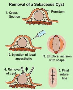 12 Sebacious cysts ideas | cysts, home remedies, natural remedies