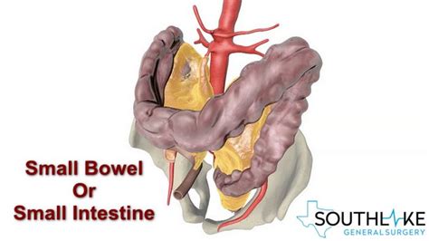 Small bowel obstruction causes treatment southlake general surgery – Artofit