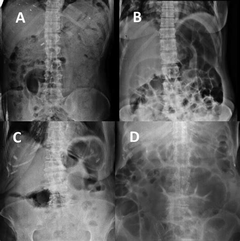 Fecal loading of colon with dilated ileal loop ( ) Fecal loading... | Download Scientific Diagram