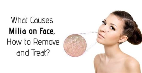 What Causes Milia on Face, How to Remove and Treat?