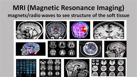 Brain Scans--A Comparison - YouTube