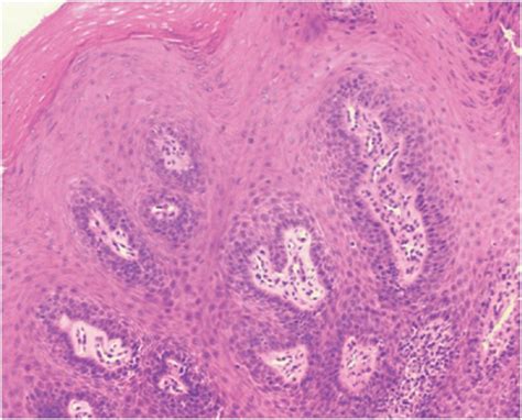 Oral squamous papilloma: a view under clinical, fluorescence and ...