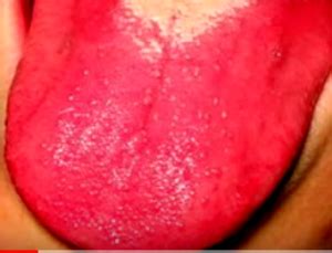 Strawberry Tongue - Causes, Pictures, Symptoms, Treatment | Health Momma