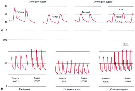 Authentication Of Radial Versus Femoral Arterial Pressure Waveform | My XXX Hot Girl