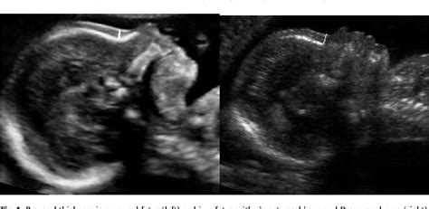 Normal Nasal Bone Ultrasound