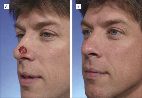 Reconstructive Perspectives of Cutaneous Defects Involving the Nasal Tip: A Retrospective Review ...