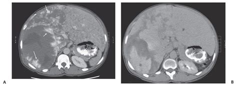 1 Hepatic Hemangioma | Radiology Key