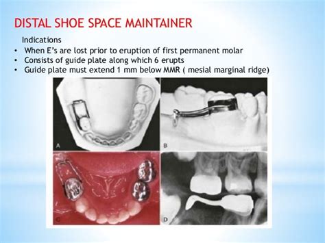 DISTAL SHOE SPACE MAINTAINER PDF