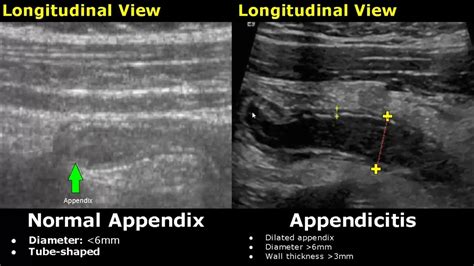 Appendix Ultrasound Normal Vs Abnormal Image Appearances | Appendicitis USG Scan - YouTube