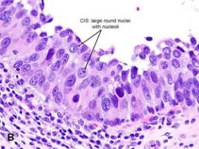 American Urological Association - Urothelial Carcinoma in Situ