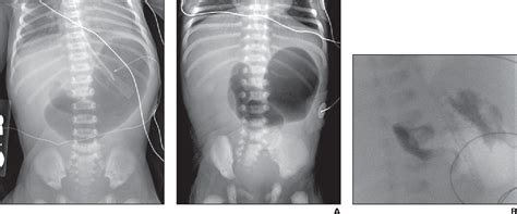 Figure 2—2 from Neonatal malrotation with midgut volvulus mimicking ...