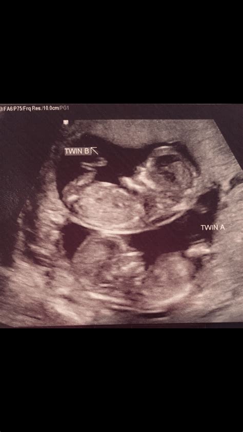 12 Weeks Pregnant Ultrasound