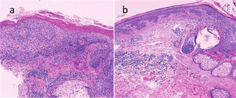 Actinic Keratosis Histology