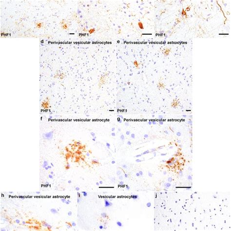 Immunotherapy treatment-related PVAs in corticobasal degeneration ...