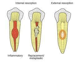 Root Resorption | Endodontist in Kingston, London | 5* Treatment