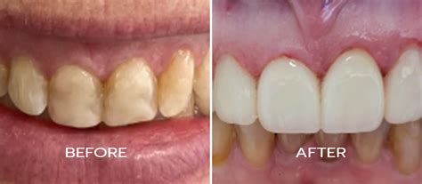 Cosmetic Before Afters | Sacramento Natural Dentistry