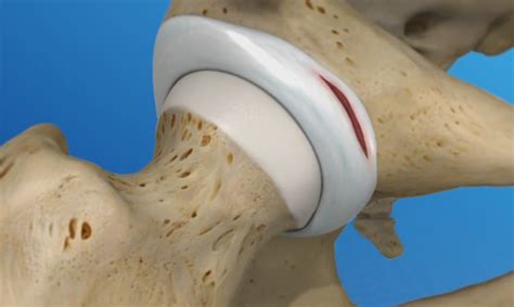 Manual Tests For Hip Labral Tear