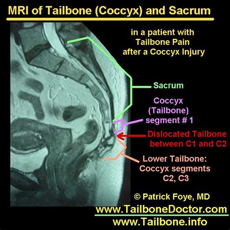 Tailbone MRI: coccyx dislocation, Tailbone Pain | Tailbone M… | Flickr