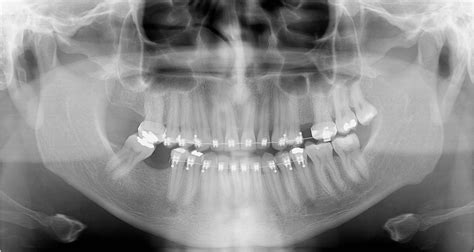 Diagnosis by Positioning Errors in Panoramic Radiographs | Semantic Scholar