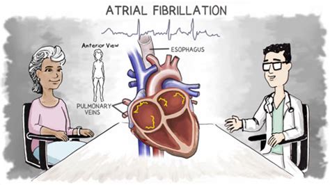 Triggers, Risk Factors, Causes | Atrial Fibrillation | AtriCure