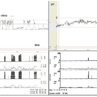 Comparison of nocturnal pH monitoring charts with nocturnal penile... | Download Scientific Diagram