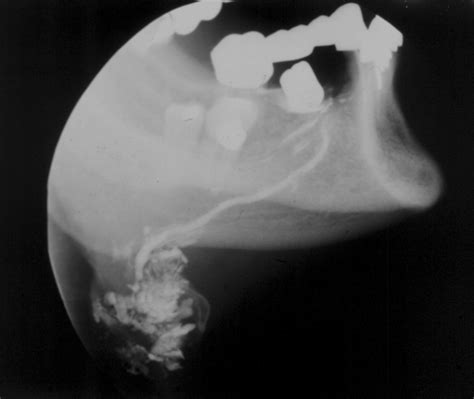 Sialogram of Sjögren’s syndrome-affected (submandibular gland ...