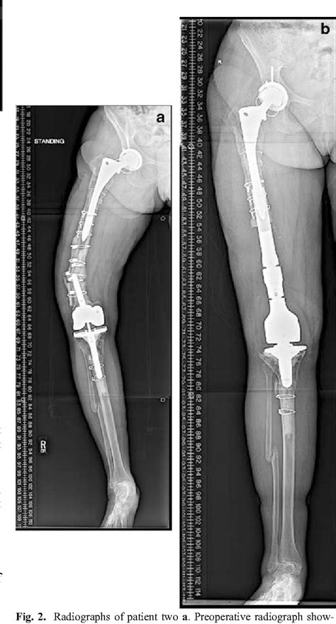 Figure 2 from Coupling Device and Distal Femoral Replacement for Periprosthetic Supracondylar ...