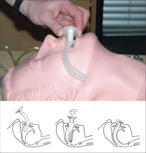 Oropharyngeal Airway And Nasopharyngeal Airway